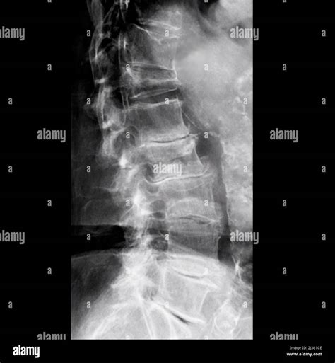 Osteoarthritis of the lumbar spine, X-ray Stock Photo - Alamy