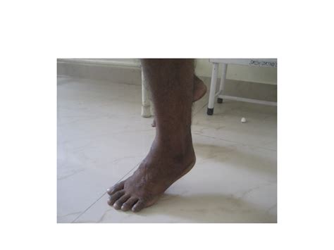 Achilles tendon injury cases management .pptx