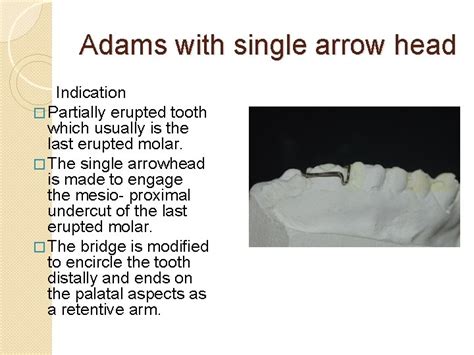 ADAMS CLASP Parts Two Arrow Heads Bridge Retentive