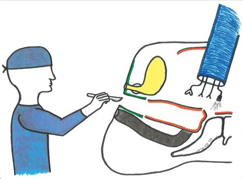 Robotics The Role Of Robotic Assisted Peritoneal Flap Augmentation In Gender Affirming