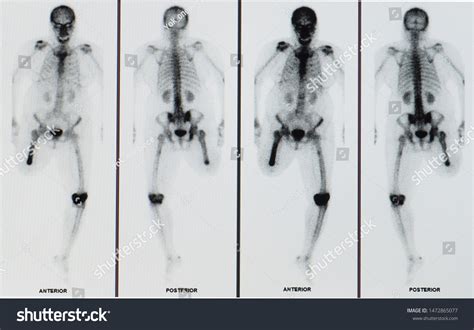 Bone Scan Scintigraphy Image Showing Patient Stock Photo (Edit Now ...