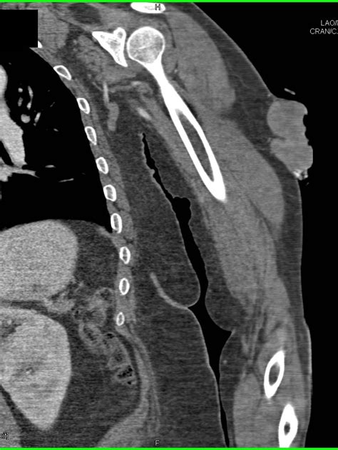 Soft Tissue Injury Ct Scan