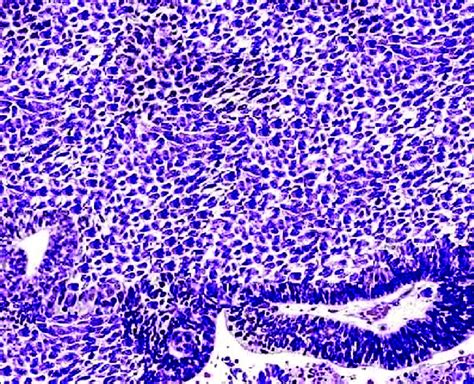 Photomicrograph Of Tumor Biopsy Showing Oval To Spindle Shaped Cells