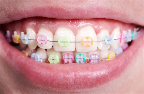 What Your Braces Colors Say About Your Personality Soleil Orthodontics