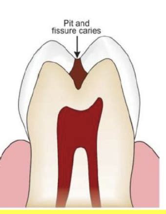 Cariology Bacteria Xerostomia Types Of Caries Flashcards Quizlet