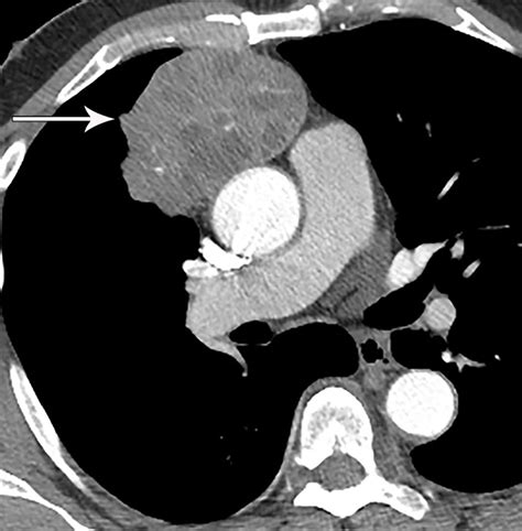 Frontiers Imaging Evaluation Of Thymoma And Thymic Carcinoma