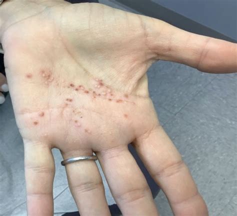 Mild Psoriasis On Palms Of Hands