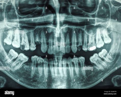 X ray of human mouth with teeth bones Stock Photo - Alamy