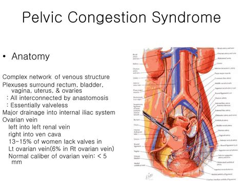 PPT Chronic Pelvic Pain Pelvic Congestion Syndrome PowerPoint