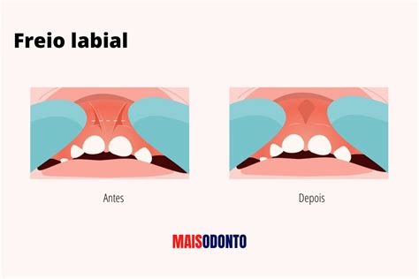 Frenectomia O que é freio labial e lingual MaisOdonto