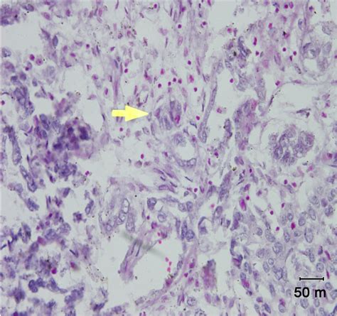 PAS positive hyaline bodies (PAS stain, 400×). | Download Scientific ...