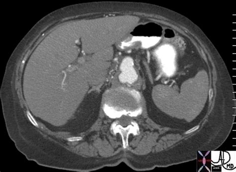 Penetrating Atheromatous Ulcer | Aorta