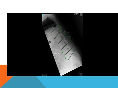 Secret Analysis Of Motion Segment Integrity Ezqmeceu Qme