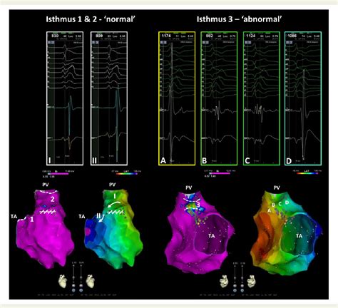 Figure From Arrhythmogenic Anatomical Isthmuses Identified By