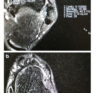 Analysis of anterior talofibular ligament (ATFL) dimension and signal... | Download Scientific ...