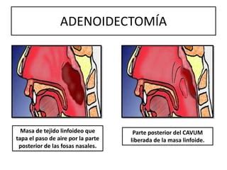 Adenotonsilectomia PPT