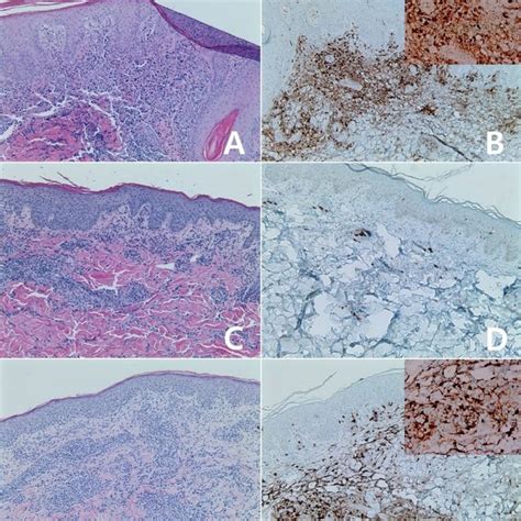 Immunohistochemistry For IDO In Primary Cutaneous CD30 Positive T Cell