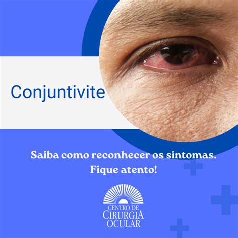 Conjuntivite Uma Vis O Detalhada Sobre Os Tipos Sintomas E