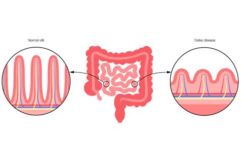 Coeliac Vs Crohn Swhat S The Difference Queensland Health