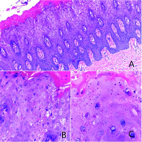 A Hyperplastic And Hyperorthokeratinized Stratified Squamous