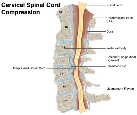 Cervical Spinal Cord Compression | Norelle Health