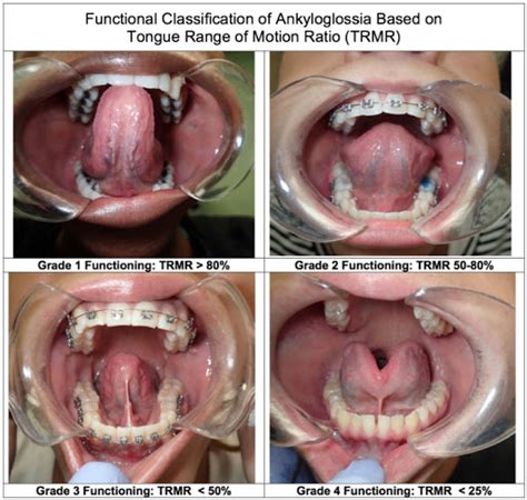 Tongue Tie Surgery