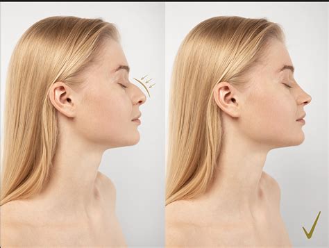 Rhinoplasty Nose Job In Istanbul Turkey Cosmetic Surgery