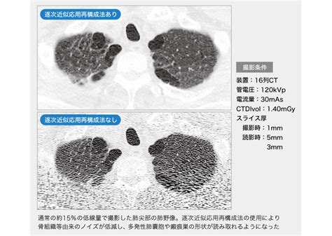 低線量ct肺がん検診の実態調査｜がん｜健康・公衆衛生学会レポート放射線｜医療ニュース｜medical Tribune