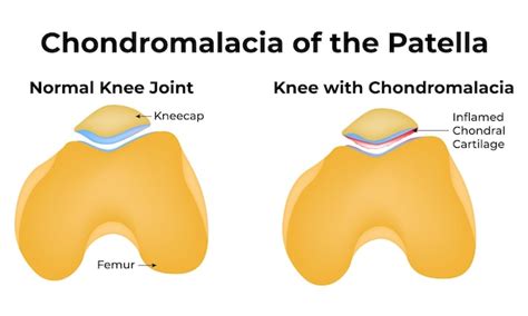 Premium Vector Chondromalacia Of The Patella Normal Knee Joint Knee