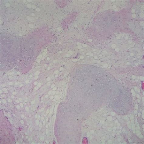 Chondrolipoma Lobules Of Mature Adipocytes With Foci Of Hyaline