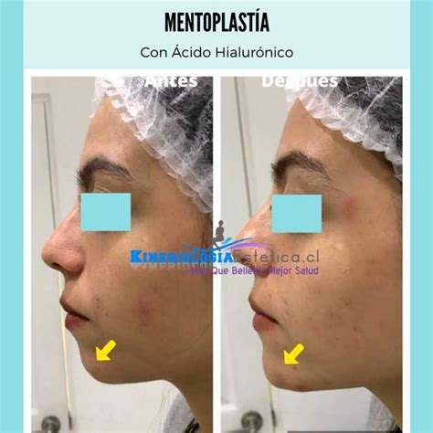 Mentoplastia Antes Y Despues Mujer Kinesiologiaestetica Cl