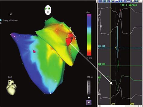 Activation Map During Ventricular Tachycardia Vt Using Carto