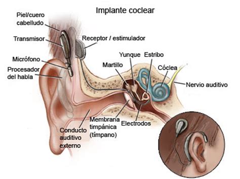 Qu Es Un Implante Coclear Y C Mo Funciona Fonolife