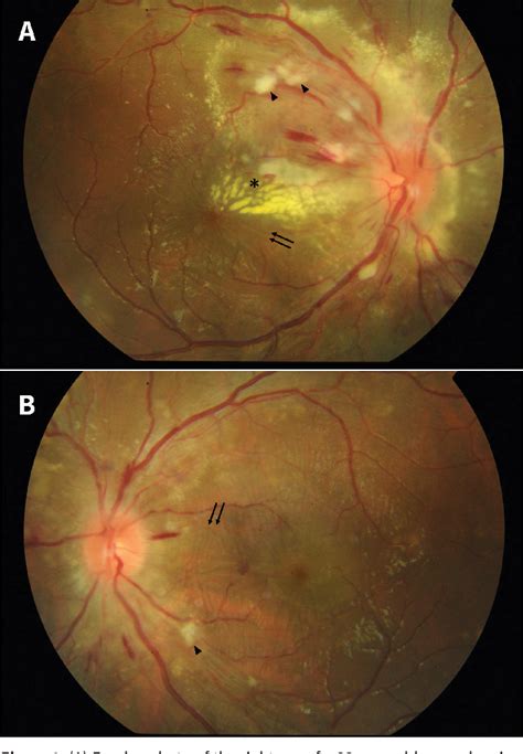 Figure From Hypertensive Retinopathy And Choroidopathy Semantic Scholar