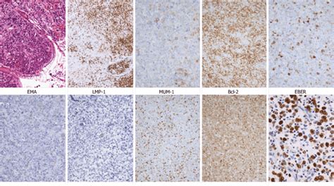 Histological Findings And Immunostaining Of The Biopsy Specimen