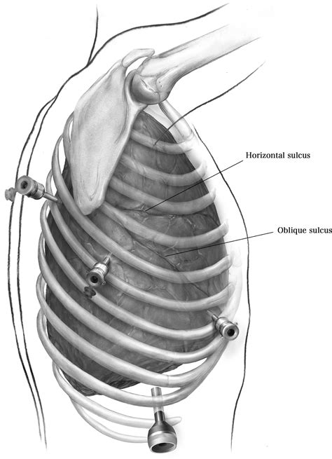 Robotic Right Lower Lobectomy Operative Techniques In Thoracic And