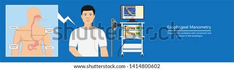 Esophageal Manometry Test Esophageal Diagnose Food Stock Vector