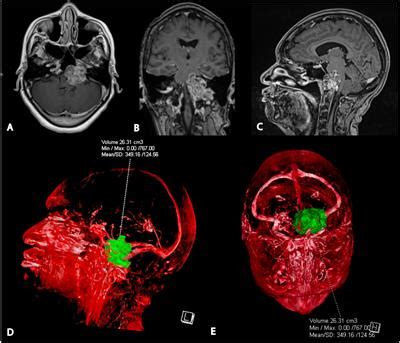 Frontiers Case Report Side Firing Intraoperative Ultrasound Guided