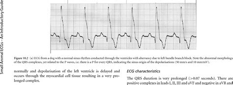 Figure 101 From Intraventricular Conduction Defects Semantic Scholar