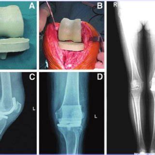 (PDF) Two-Stage Primary Total Knee Arthroplasty with Well-Designed ...