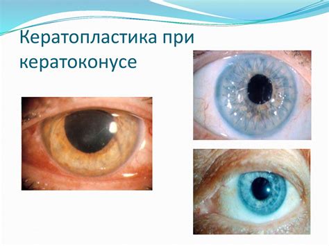 Кератиты. Заболевания роговицы - презентация онлайн