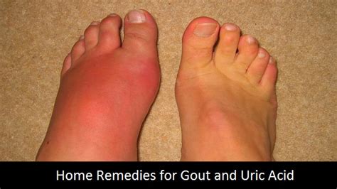 Home Remedies To Treat Gout And Uric Acid Healthy Tips