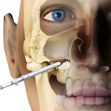 Podniesienie dna zatoki szczękowej Denticus dentysta stomatolog