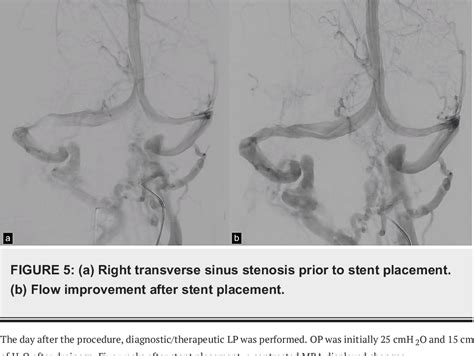 Pdf Coronary Stent For Right Transverse Venous Sinus Stenosis In A