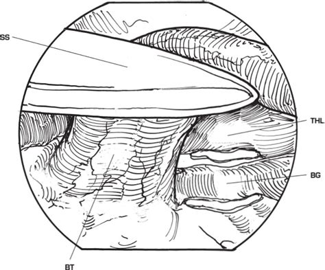 Arthroscopic Elbow Debridement And Loose Body Removal For Valgus Extension Overload “pitchers