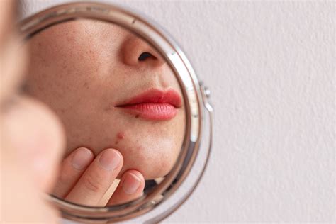 How To Treat Those Pesky Pimples Around Your Mouth Software