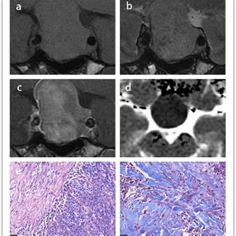 A 57 Year Old Female With A Soft Pituitary Adenoma The Tumor In The