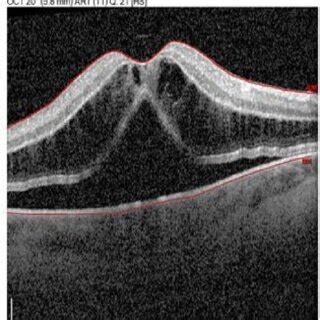 Optical Coherence Tomography Of Macula St Postoperative Day Cystoid