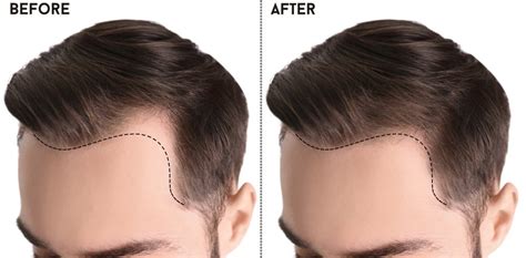 Hair Transplant In Turkey