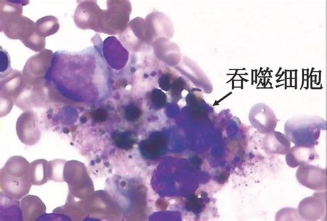 汇总！118张血细胞典型形态学图谱形态学图谱胞浆细胞泡沫状 健康界